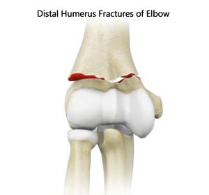 Distal Humerus Fractures of the Elbow/ORIF