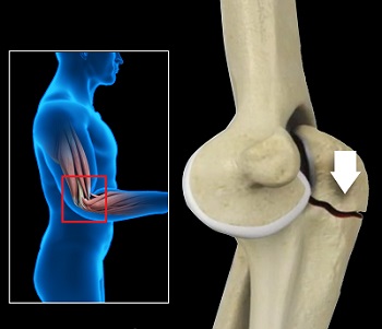 Olecranon Fractures/ORIF