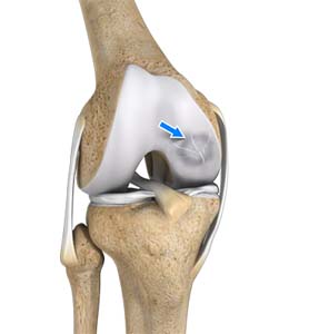 Elbow Osteochondritis Dissecans