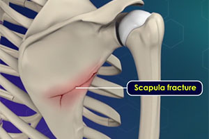 Scapula Fractures