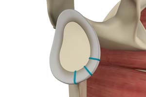 Instability Repair