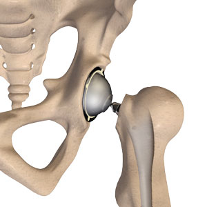 Total Hip Arthroplasty