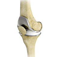 Total Hip Arthroplasty