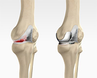 Total Hip Arthroplasty